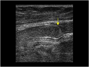 Slow flow in the distal brachial vein and normal valve