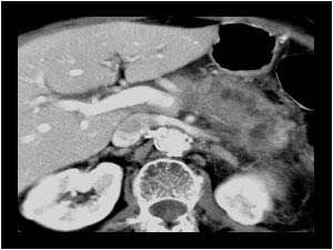 Malignant pancreatic tumors in corpus and cauda