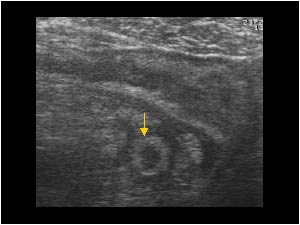 Appendicitis transverse and a thickened ileocecal wall