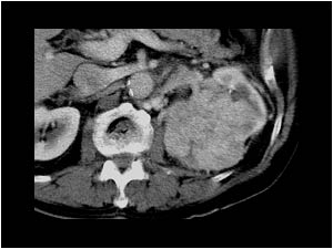 Varicoceles and renal cell tumor