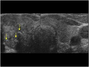 Inhomogeneous ill defined mass with calcifications in the right thyroid lobe transverse