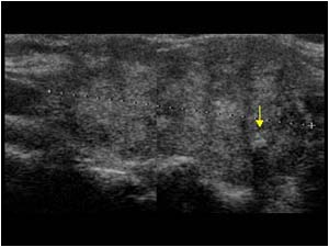 Inhomogeneous ill defined mass with calcifications in the right thyroid lobe longitudinal