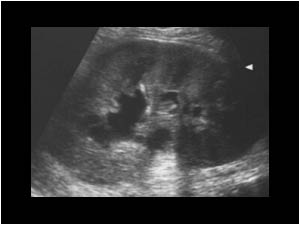 Left kidney with localized dilatation of the collecting system