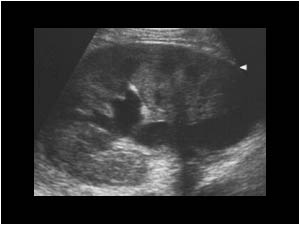 Left kidney with localized dilatation of the collecting system longitudinal