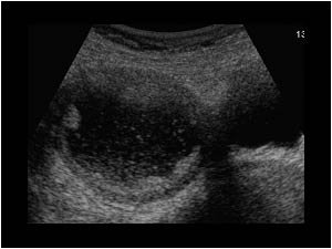Fluid filled uterine cavity and an irregular wall