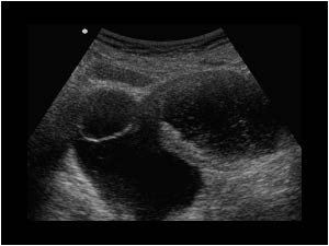 Endometrial carcinoma benign cystic mass in the right ovary