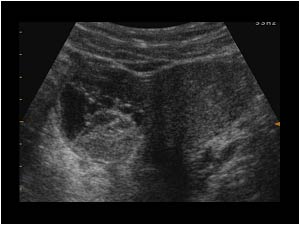 Right ovary with follicles and ruptured follicle cyst