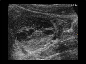 Right ovary with follicles and ruptured follicle cyst