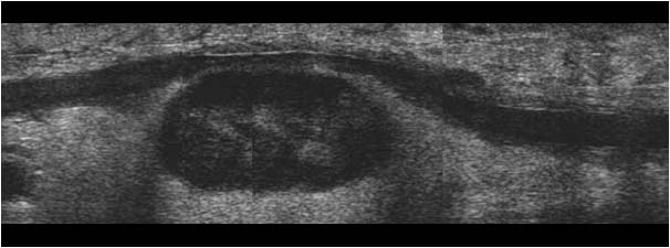 Lympheadenitis and phlebitis in the elbow longitudinal