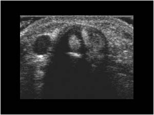 Tenosynovitis of de Quervain on the right side transverse