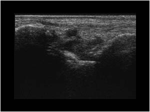 Synovial thickening and effusion of the carpal joints