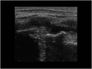 Synovial thickening and effusion of the carpal joints