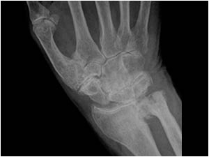 Extensor tendons dorsal side of the wrist: Fifth compartment