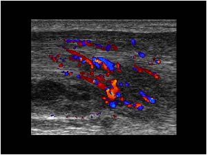 Thickening of the tendons and hypervascularity longitudinal