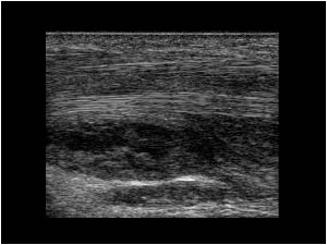 Thickening of the tendons and synovial thickening longitudinal