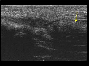 Flexor tendon rupture with proximal stump longitudinal