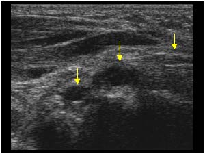 Arthrosynovial cysts and median nerve transverse