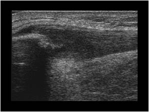 Thickened patellar tendon and focal tendinosis longitudinal