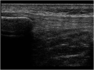 Normal left patellar tendon longitudinal