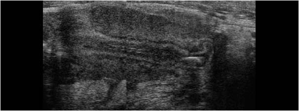 Case of the month April 2005: Abnormalities mimicking an acute appendicitis