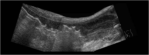 Case of the month April 2005: Abnormalities mimicking an acute appendicitis
