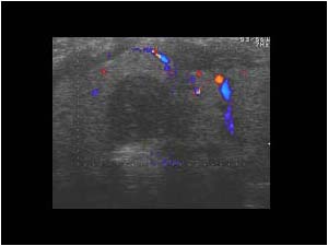 Thyroid metastasis of a renal cell carcinoma
