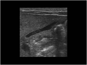 Case of the month September 2005: Gallstones