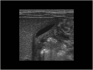 Case of the month September 2005: Gallstones