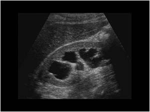 Right kidney with dilatated collecting system longitudinal
