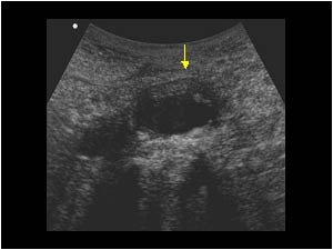Transverse image with regression of the mass around the aorta