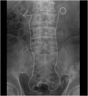 Plain abdominal X ray showing a stent in the right and left ureter