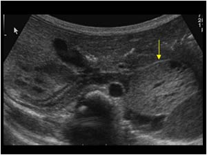 Case of the month December 2005: Abdominal and retroperitoneal tumors in infants