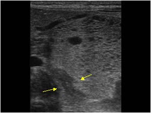 Extrapulmonary sequestration with a microcystic mass and left adrenal