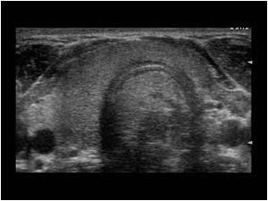 Hypoplasia of the left thyroid lobe transverse