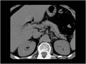 CT scan shows air in the biliairy tree