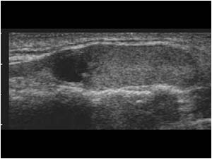 Ectopic thyroid tissue with a small cystic nodule longitudinal