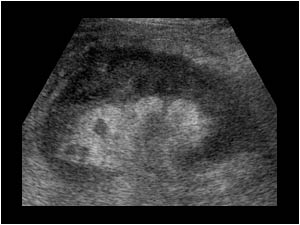 Enlarged left kidney and an infiltrating mass in the perirenal tissues longitudinal