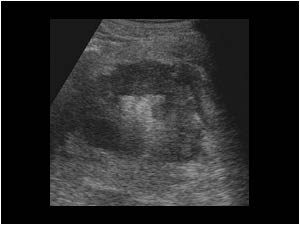 Enlarged left kidney and an infiltrating mass in the perirenal tissues transverse
