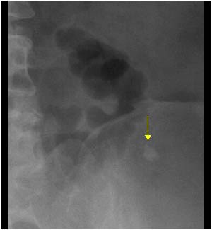 A control plain abdominal film shows the calcification in a more lateral position