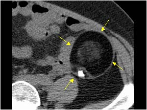 Dermoid cyst with calcification on the left side