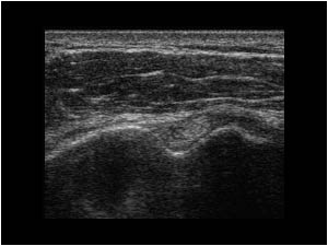 Normal bicipital groove and tendon transverse