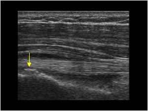 Irregular lesser tubercle after a fracture and biceps tendon longitudinal