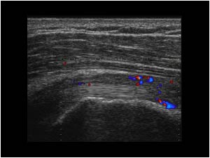 Biceps tendon tendinopathy with thickend hypervascularized synovium longitudinal