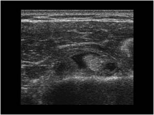 Biceps tendon tendinopathy with thickened hypervascularized synovium transverse