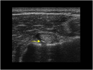 Loose body in the bicipital groove transverse