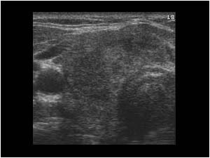 thyroiditis ultrasound pictures