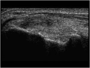Thickened inhomogeneous common flexor tendon longitudinal