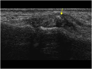 Ulnar collateral ligament rupture with interposition and a small avulsion longitudinal