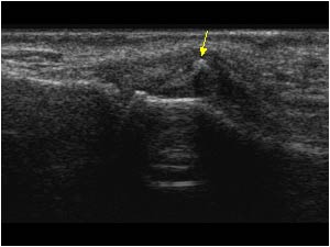 Ulnar collateral ligament rupture with interposition and a small avulsion longitudinal