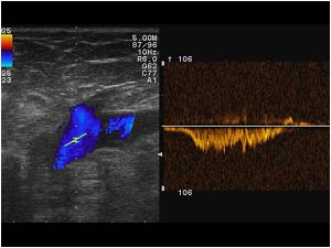 Normal flow in the proximal common femoral vein